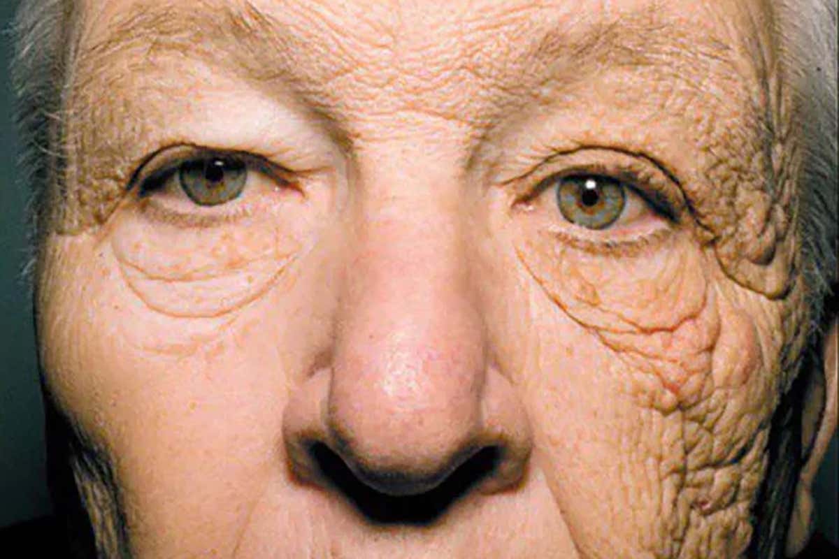 The wrinkled left side of William McElligott's face after being exposed to the sun